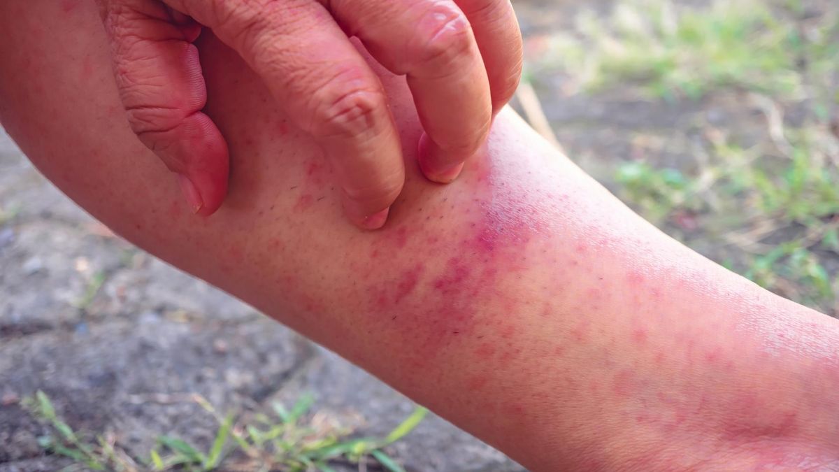 Ukąszenia meszek mogą być szczególnie dotkliwe dla alergików