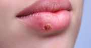Jak wyleczyć opryszczkę w ciąży?