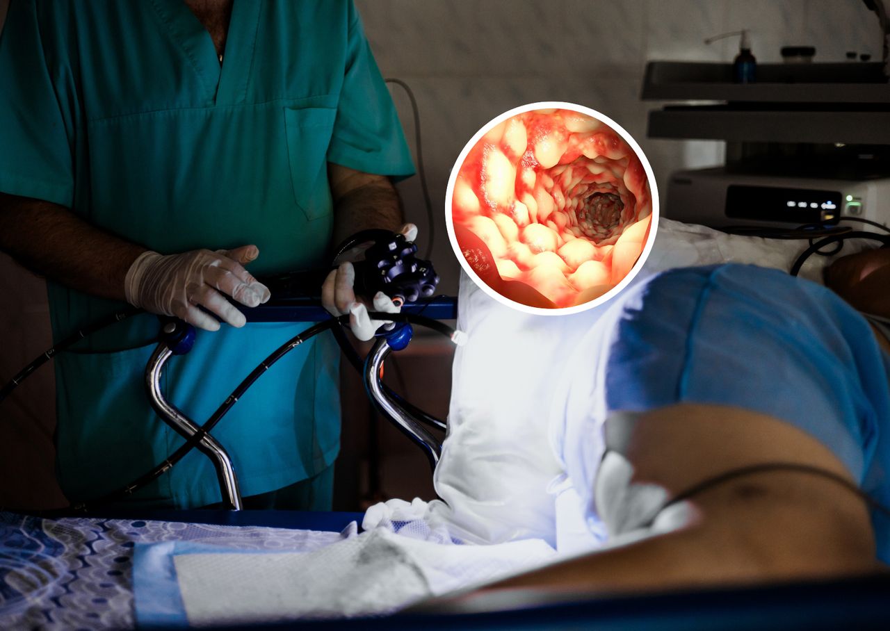 Preludium do raka jelita grubego. Ryzyko rośnie pięciokrotnie