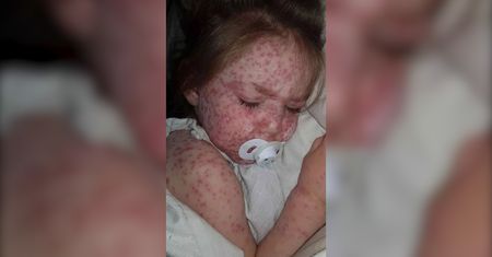 Myślała, że dziecko ma ospę. Lekarze byli w szoku, gdy ją zobaczyli