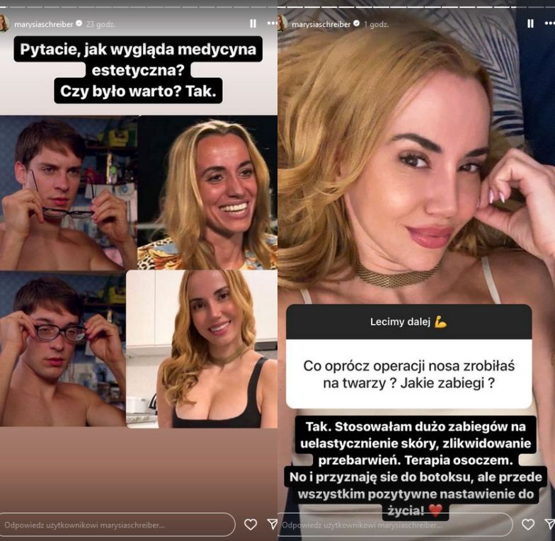 Marianna Schreiber szczerze o zabiegach medycyny estetycznej