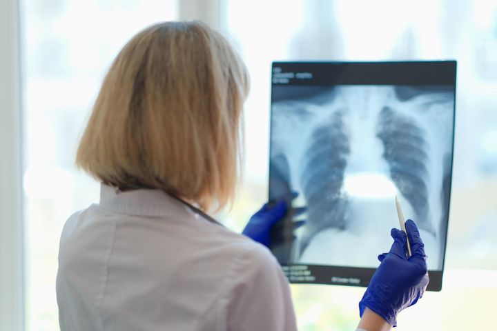 Ropień płucny to rzadka choroba układu oddechowego, która może stanowić zagrożenie dla życia.