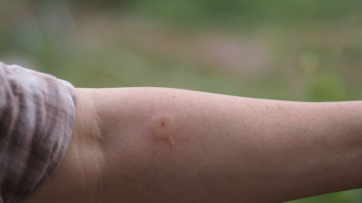 Wasp,hornet stings arm woman red swelling
Wasp,hornet stings arm woman red swelling
Penpak Ngamsathain