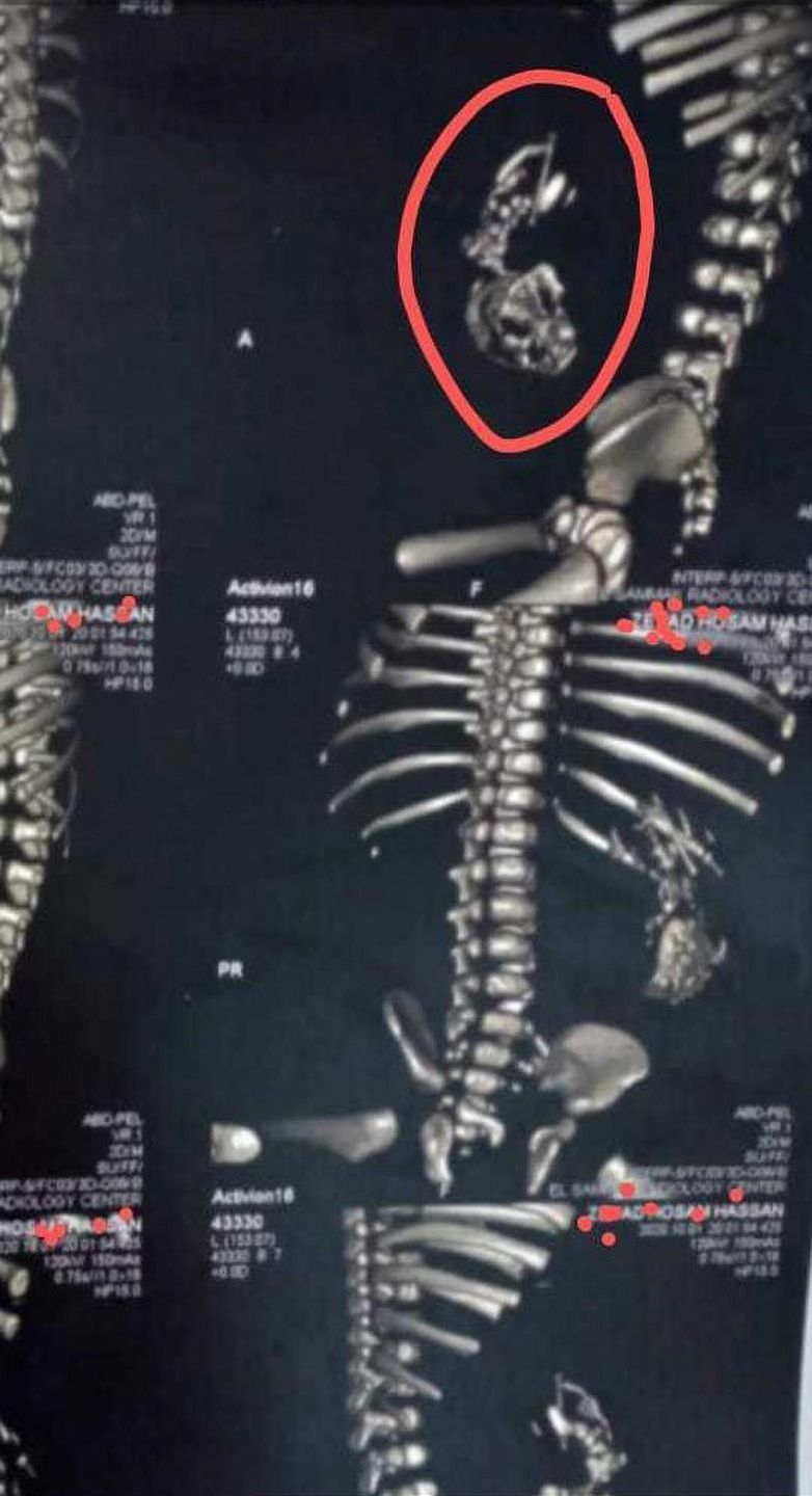 Jeden z płodów wchłonął drugi