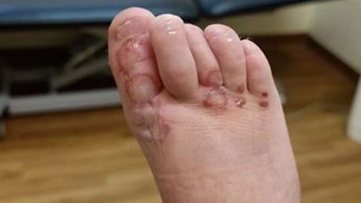 Bieżnia wciągnęła stopy rocznej dziewczynki