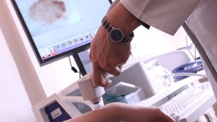 „Największym błędem jest poleganie tylko na kremach z filtrem”. Co naprawdę chroni przed czerniakiem?