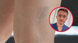 Ogromne żylaki nawet u młodych ludzi. Lekarz wyjaśnia przyczynę