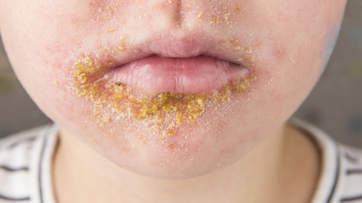 Liszajec zakaźny wywołują gronkowce i paciorkowce, tworząc mieszane zakażenie skóry, najczęściej w okolicy ust i nosa.