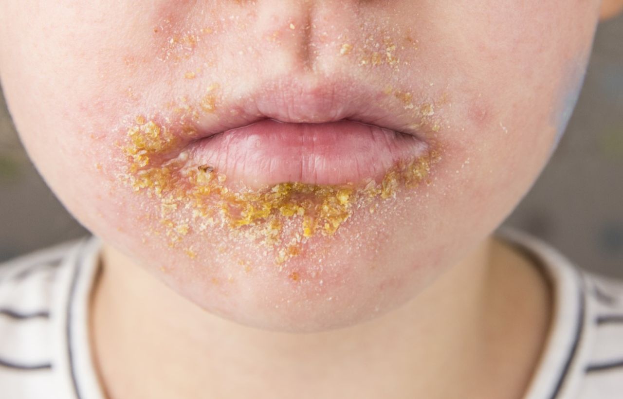 Liszajec zakaźny - przyczyny, objawy, diagnostyka, leczenie, powikłania, domowe sposoby