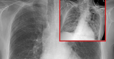 Koronawirus. Pokazał zdjęcia, na których widać obraz płuc chorego na COVID-19
