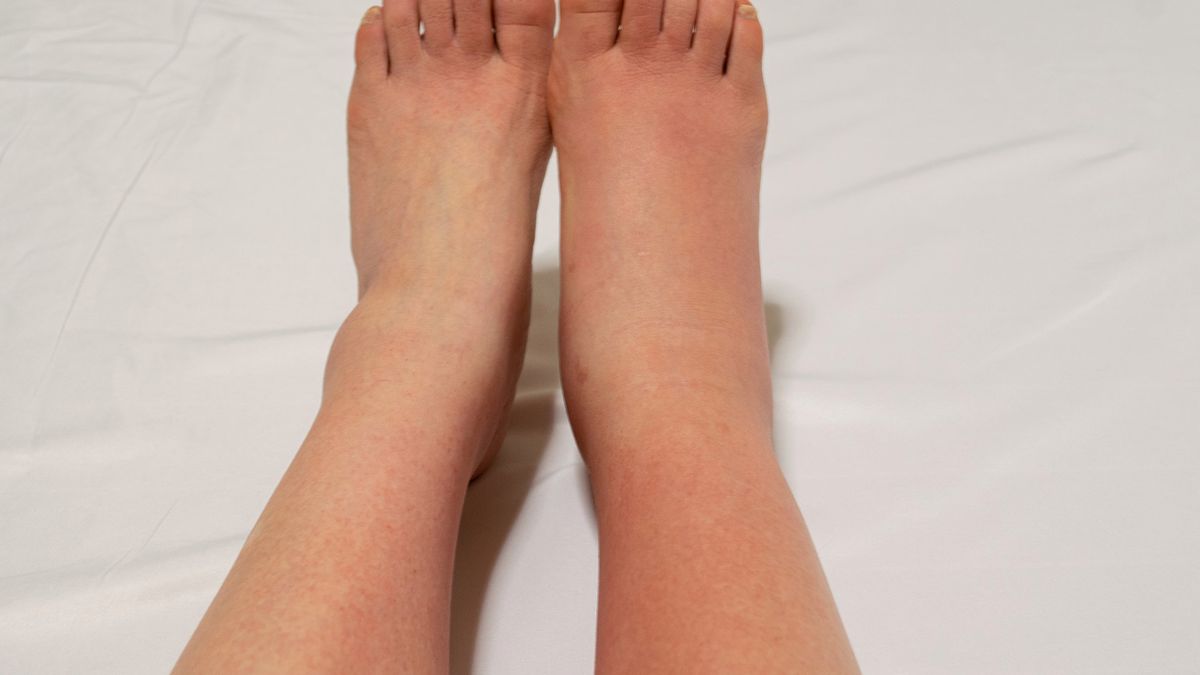 Pojawia się po jednej stronie ciała. To znak, że w organizmie kumulują się szkodliwe substancje