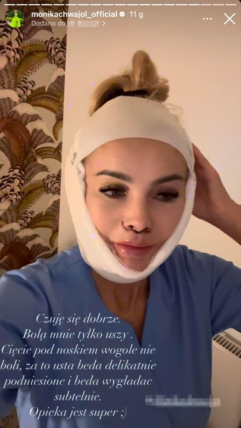 Monika Chwajoł zrobiła sobie lifting i lip lift