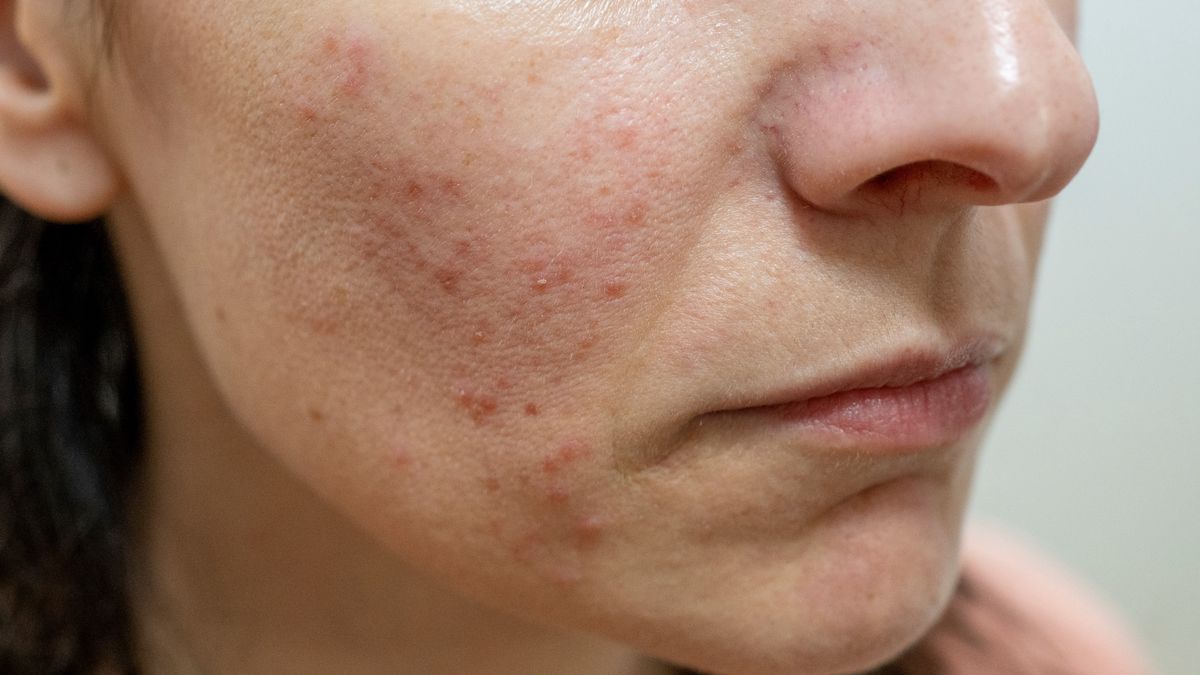 Mydło dziegciowe pomaga w walce z trądzikiem