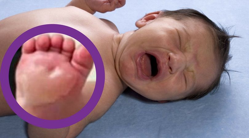 Niania spowodowała poparzenia 2 stopnia 6-miesięcznemu dziecku