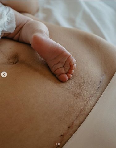 Klaudia Halejcio pokazuje brzuch po porodzie przez cesarskie cięcie