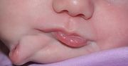 Nietypowa wada genetyczna. Dziecko urodziło się z dodatkowymi ustami