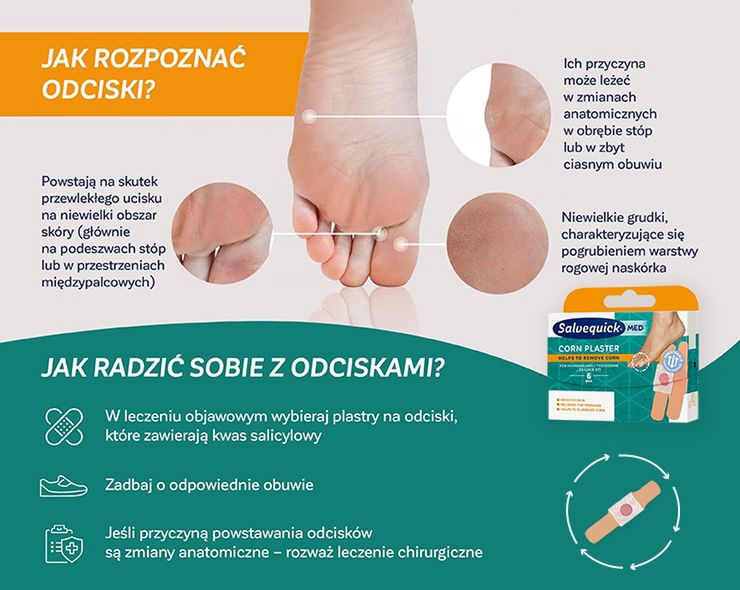 odciski – jak rozpoznać i jak sobie z nimi radzić