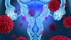 Pierwsze objawy raka trzonu macicy #ZdrowaPolka