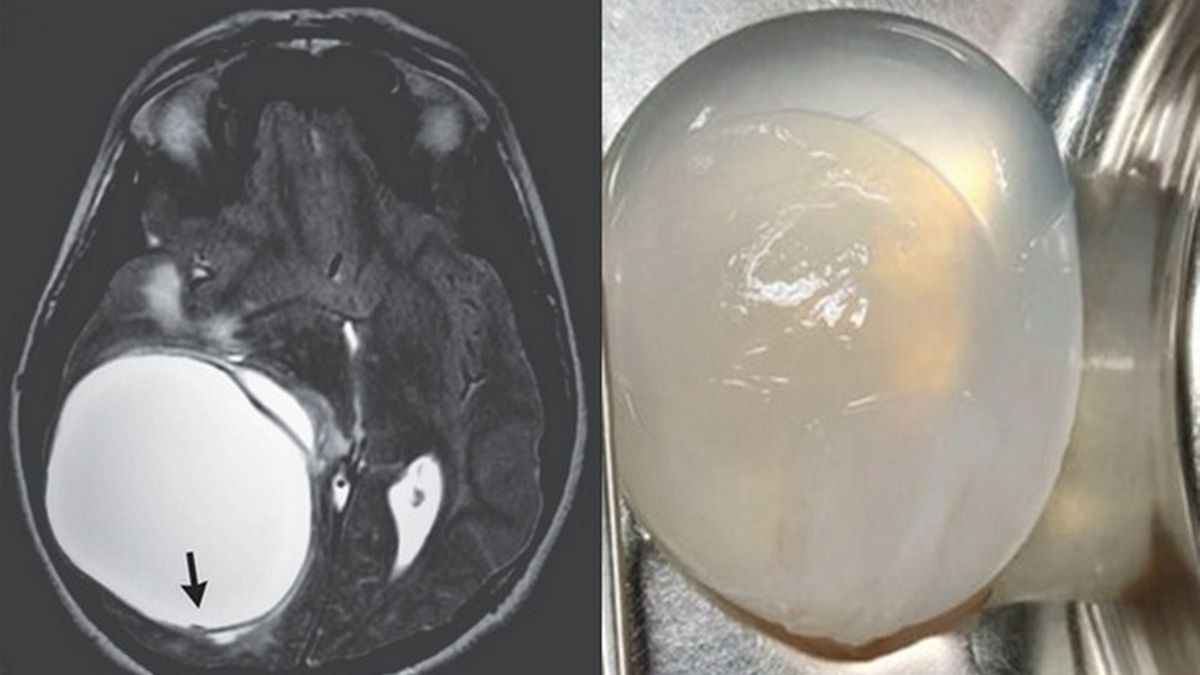 Kilkunastolatek zaraził się bąblowicą. To choroba przenoszona przez tasiemce
