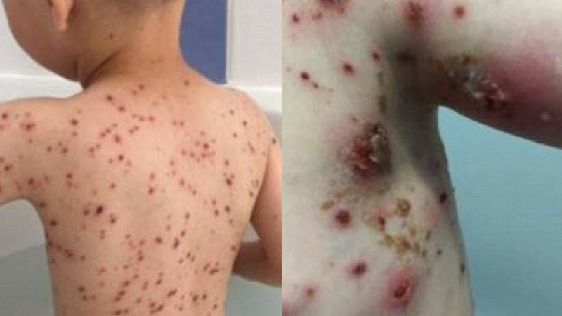 Skutki podawania ibuprofenu dzieciom w trakcie ospy