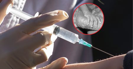 Małpia ospa. Niemcy będą się szczepić?