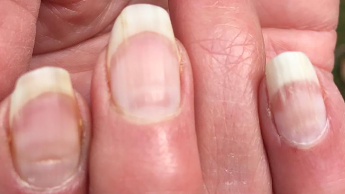 Dziwne zmiany na paznokciach mogą być efektem koronawirusa
