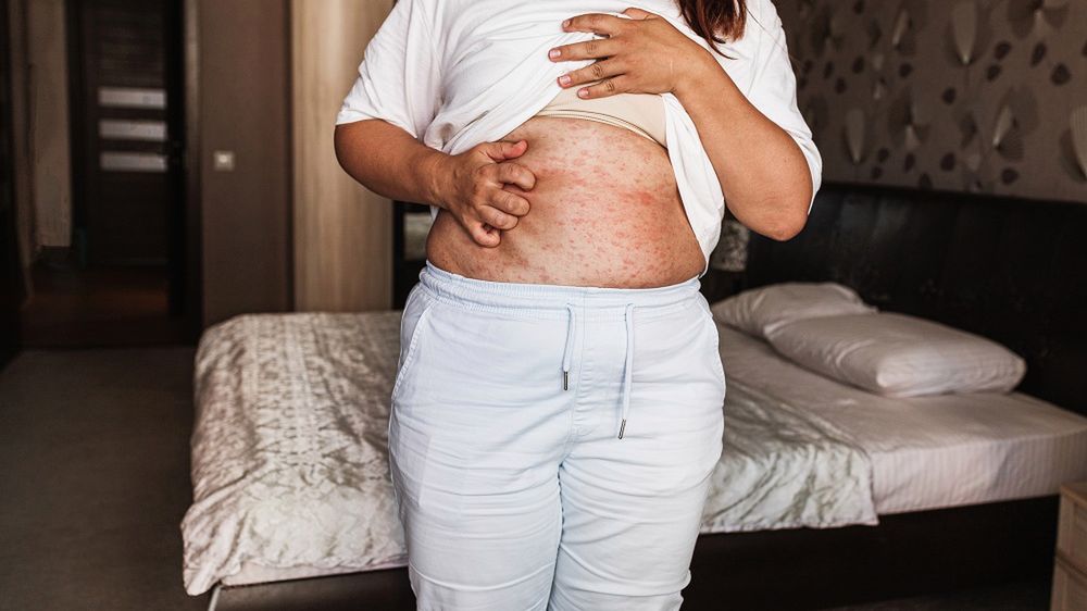 Niedobory witamin mogą dawać objawy skórne