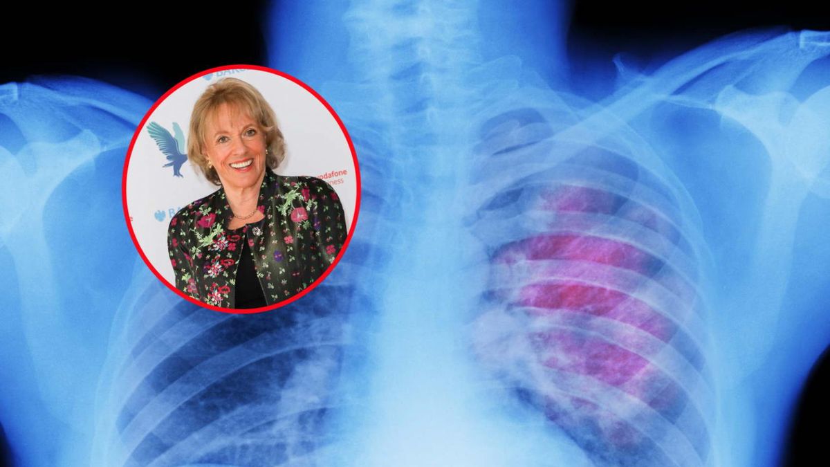 Wczesne rozpoznanie objawów raka płuc, pozwala wcześniej go wykryć i wdrożyć odpowiednie leczenie