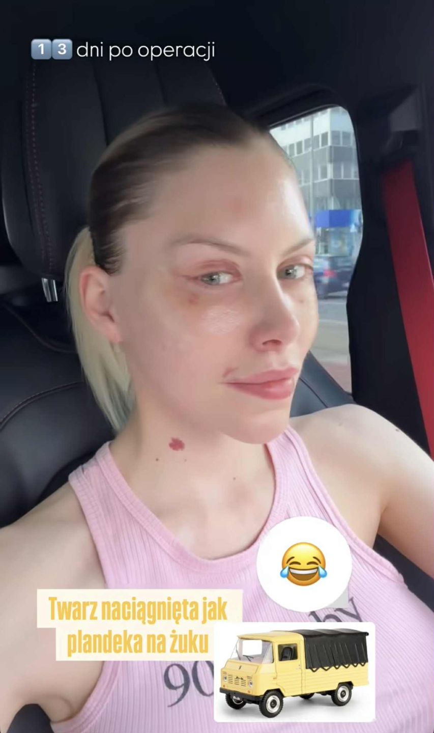 Julia von Stein pokazała zliftingowaną twarz 13 dni po operacji