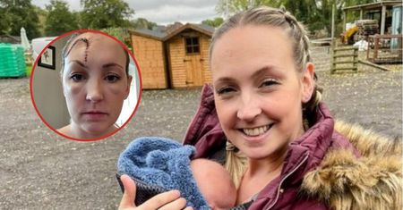 Znamię na czole okazało się nowotworem. Młoda mama przez lata bagatelizowała objawy czerniaka