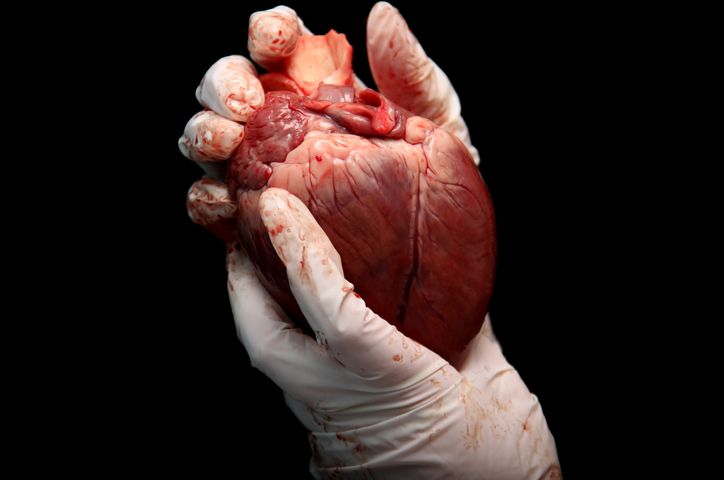 Przeszczep serca to inaczej zabieg transplantacji serca.