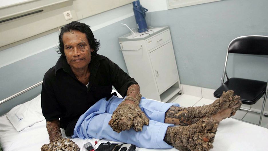 Smutny koniec historii indonezyjskiego Człowieka Drzewo. Umierał samotnie w szpitalu