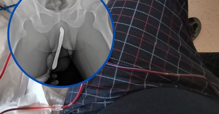 Szokujący uraz 43-latka. Mężczyzna tak złamał prącie
