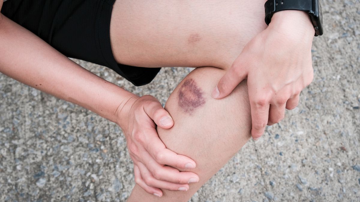 Siniaki na nogach z reguły są skutkiem upadku lub uderzenia, mogą jednak wystąpić w powiązaniu z innymi dolegliwościami.