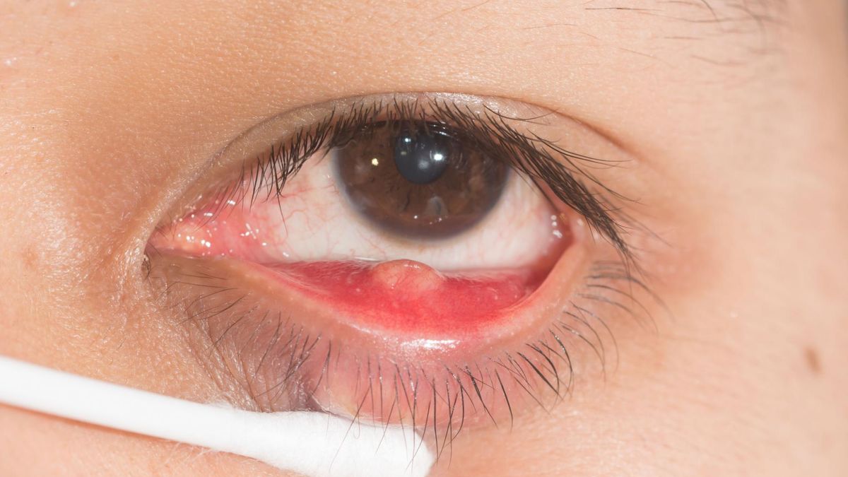 Gradówka często ustępuje samoistnie