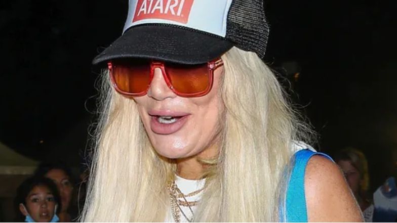 Tori Spelling pokazuje twarz po zabiegach medycyny estetycznej