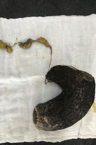 Trichobezoar odkryty w żołądku pięciolatki