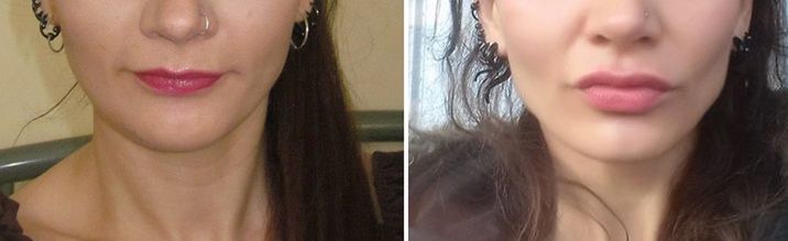 Coraz więcej osób wypełnia usta kwasem hialuronowym