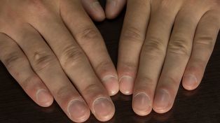 Prosty test może ujawnić raka płuc. Objawy mogą być widoczne na palcach