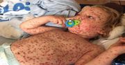 Najgorszy przypadek ospy wietrznej wystąpił u dwulatka