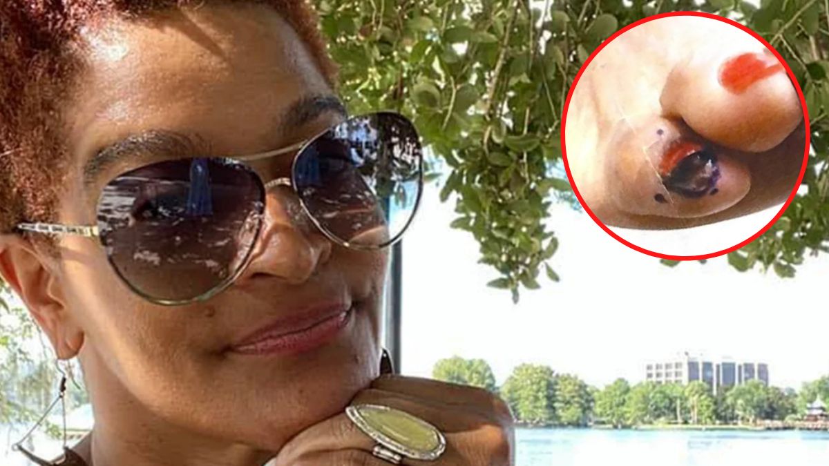 Chorowała na czerniaka podpaznokciowego