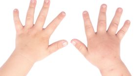 Opuchlizna na palcach i dłoniach - jakie choroby może oznaczać? (WIDEO)