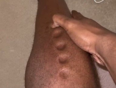 Na nodze sportowca pojawiały się widoczne wgniecenia