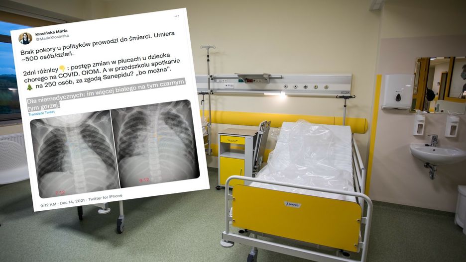 COVID-19 wśród dzieci. Lekarka pokazała zdjęcie 