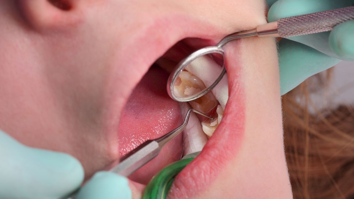 Dziura w zębie wymaga natychmiastowego leczenia, które jest mniej bolesne niż leczenie większych ubytków.