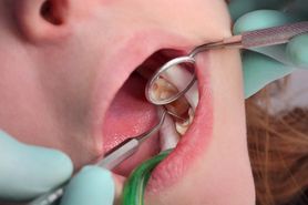 Dziura w zębie – czym jest, leczenie, zapobieganie