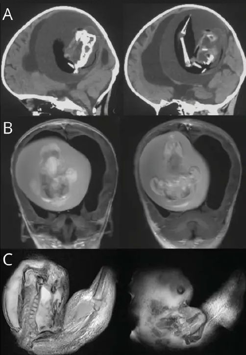 W mózgu dziewczynki znajdowała się pasożytnicza bliźniaczka