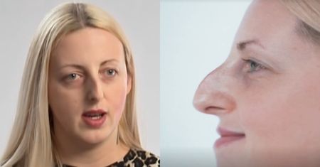 Bohaterka programu Małgorzaty Rozenek miała kompleks nosa. Przeszła olbrzymią metamorfozę (FOTO)
