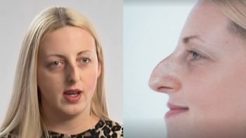 Bohaterka programu Małgorzaty Rozenek miała kompleks nosa. Przeszła olbrzymią metamorfozę (FOTO)