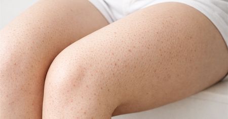 Masz takie kropki na nogach? Zmień nawyki pod prysznicem. To klucz